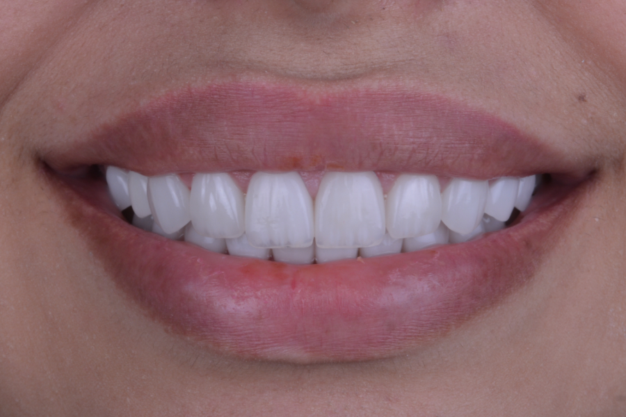 بعد تغير لون و شكل الأسنان لإعادة تأهيل الابتسامة.